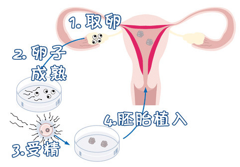 三代试管代怀生子